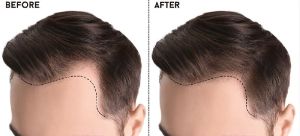 Professional Hair Transplantation In Punjab