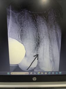 Root Canal Treatment