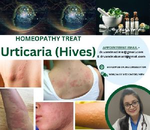 Online Homeopathy Consultation Services Urticaria Skin Problem