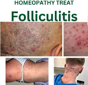 Best Homeopathy Doctor For Skin Problem Folliculitis
