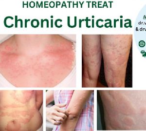 Best Homeopathy Doctor For Skin Problem Chronic Urticaria