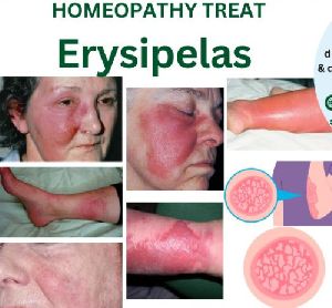 Best Homeopathy Doctor For Skin Problem Erysipelas