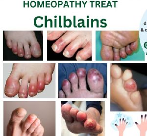 Online Doctor Consultations For Skin Problem Chilblains