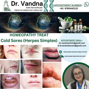 Online Homeopathy Consultation Services For Skin Problem Cold Sores